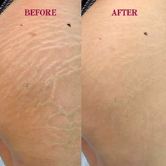 Markless Veil – Stretch Mark Serum - RaybyrafiaMarkless Veil – Stretch Mark SerumRaybyrafiaRaybyrafia1000Markless Veil – Stretch Mark SerumMarkless Veil – Stretch Mark Serum