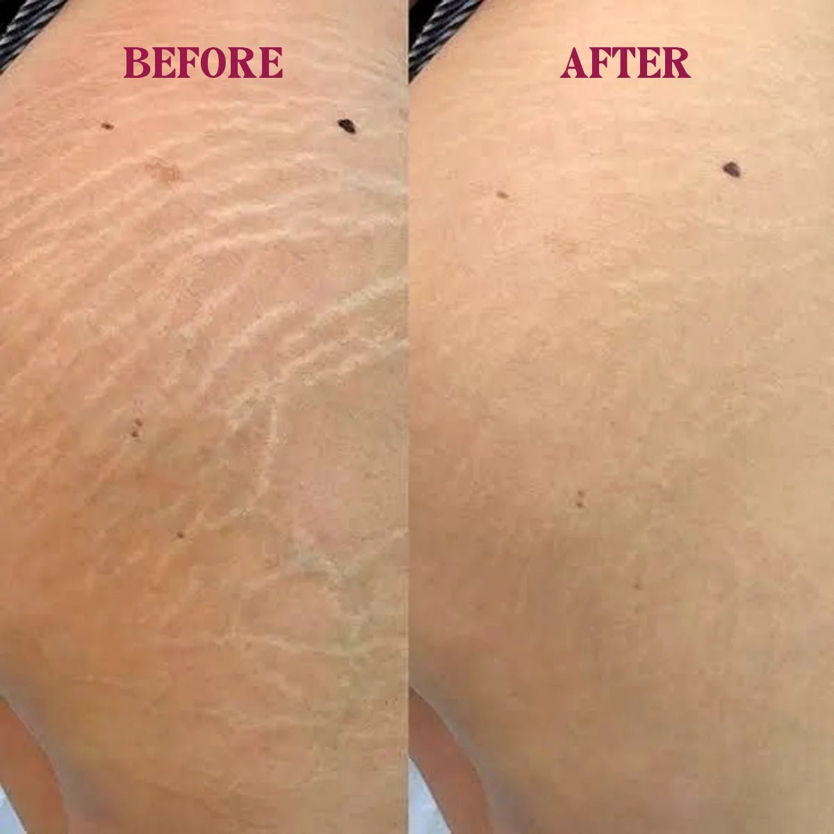 Markless Veil – Stretch Mark Serum - RaybyrafiaMarkless Veil – Stretch Mark SerumRaybyrafiaRaybyrafia1000Markless Veil – Stretch Mark SerumMarkless Veil – Stretch Mark Serum